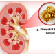 Illustration for article titled obat batu empedu batu ginjalem/em